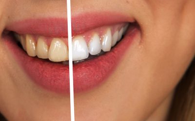 Tanden bleken: eenvoudig een witte lach